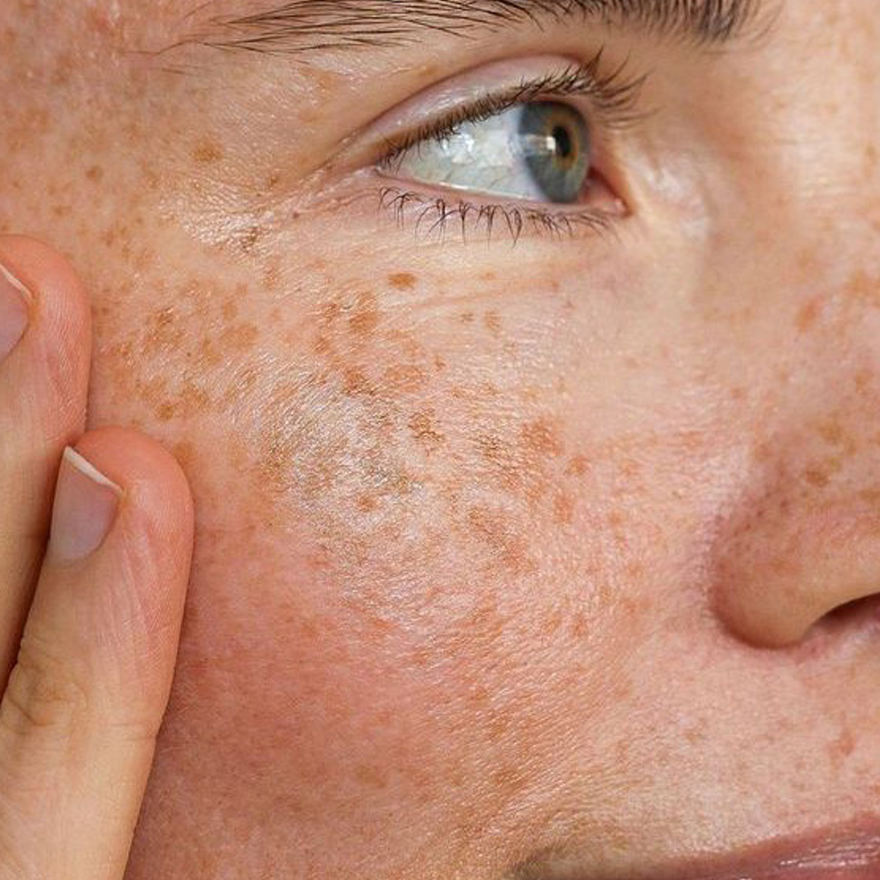 Top Ingredients for Sensitive Skin (and What to Avoid)