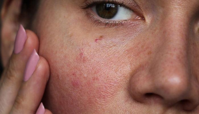 What Is Rosacea? Symptoms, Triggers & How to Calm Sensitive, Red Skin